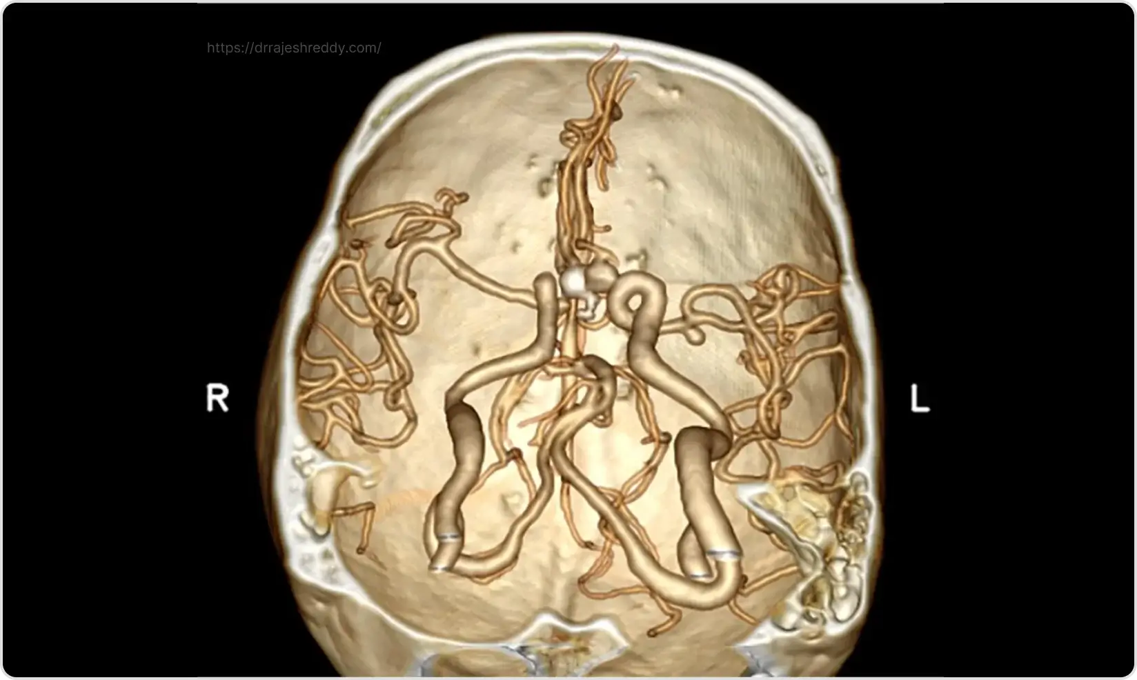 CT Angiogram Brain